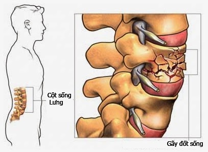 Chấn thương lưng - Ảnh minh họa 1