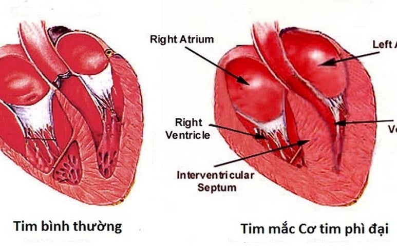 Cơ tim phì đại - Ảnh minh họa 2