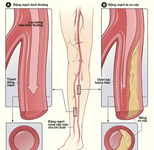 Peripheral arterial disease - Ảnh minh họa 4