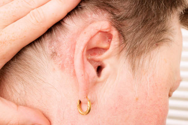 Psoriatic Arthritis - Ảnh minh họa 5