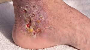 Cellulitis - Ảnh minh họa 1