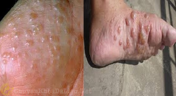 Cellulitis - Ảnh minh họa 2