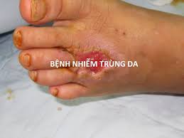 Cellulitis - Ảnh minh họa 4