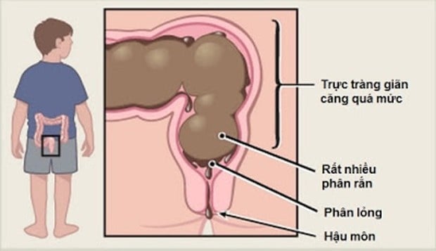 Phân khô cứng trong trực tràng - Ảnh minh họa 3