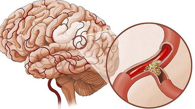 Rối loạn tuần hoàn não - Ảnh minh họa 3