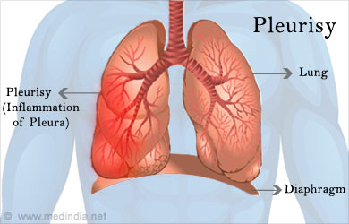 Pleuritis - Ảnh minh họa 3