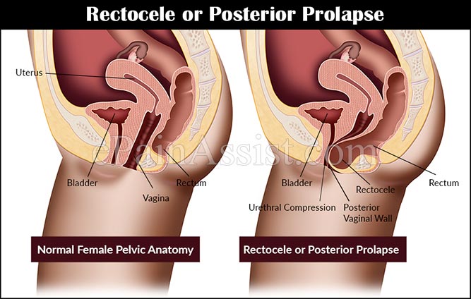 Rectocele - Ảnh minh họa 1