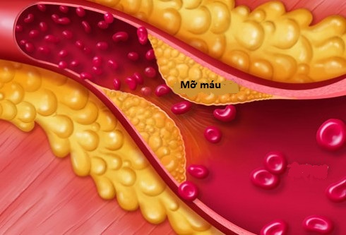 Cholesterol máu cao - Ảnh minh họa 2