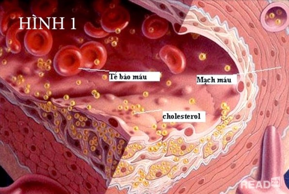 Cholesterol máu cao - Ảnh minh họa 3