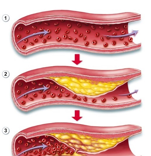 Cholesterol máu cao - Ảnh minh họa 4