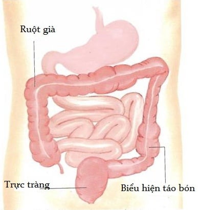 Phân khô cứng trong trực tràng - Ảnh minh họa 4