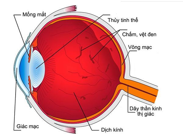 Ruồi bay đục dịch kính - Ảnh minh họa 1