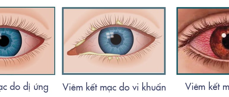 Conjunctivitis - Ảnh minh họa 3