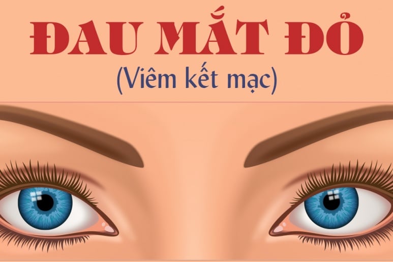 Conjunctivitis - Ảnh minh họa 2