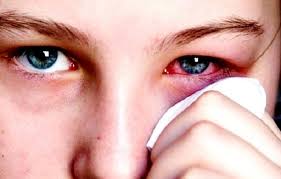 Conjunctivitis - Ảnh minh họa 4