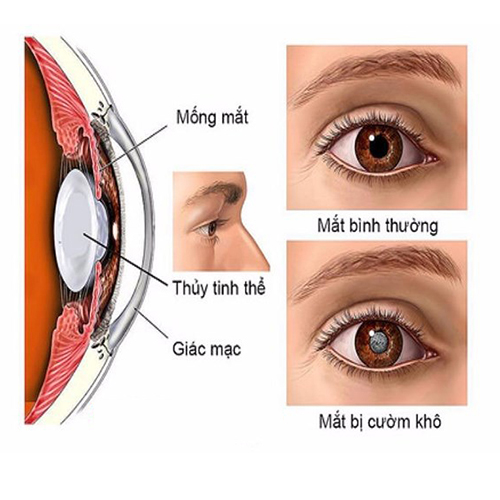 Phacoscotasmus - Ảnh minh họa 2