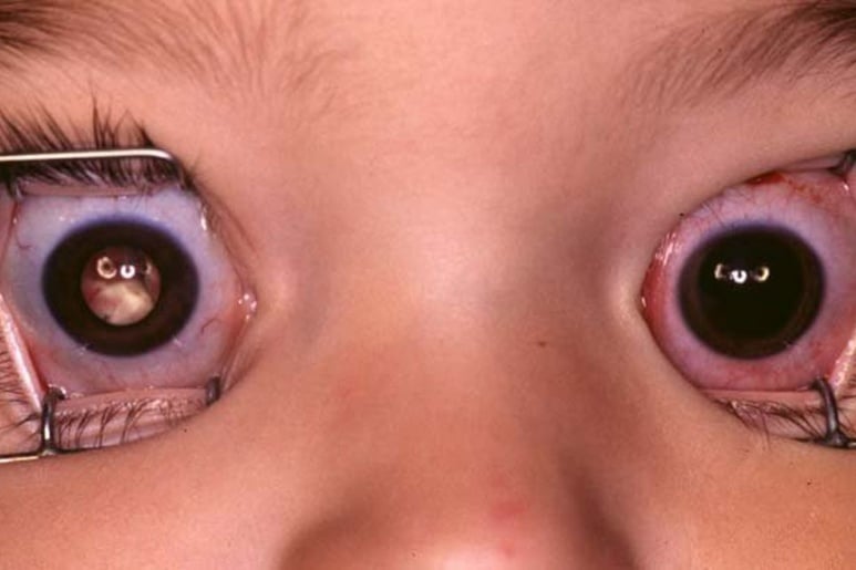 Retinoblastoma - Rb - Ảnh minh họa 2