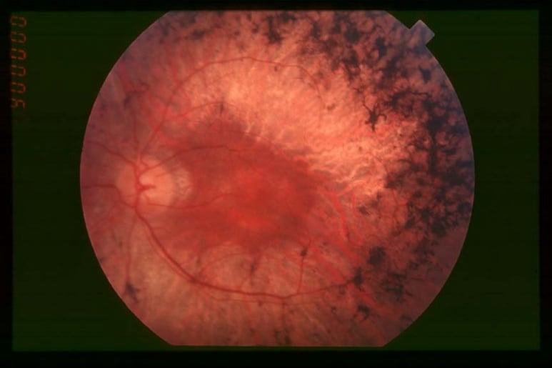 Retinitis Pigmentosa - Ảnh minh họa 4