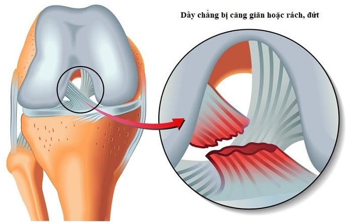 Rách dây chằng - Ảnh minh họa 2