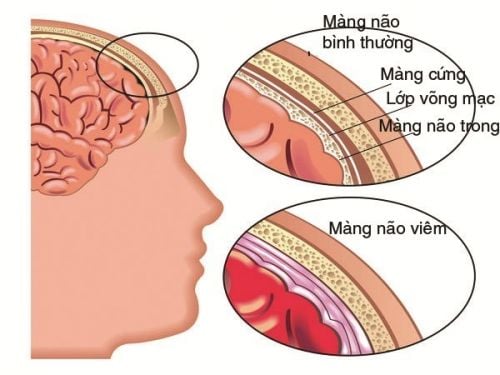 Rocky Mountain spotted fever - Ảnh minh họa 1