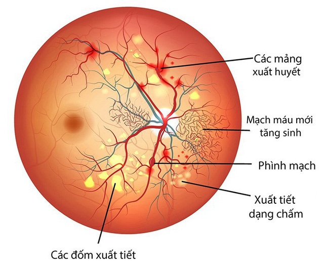 Retinopathy - Ảnh minh họa 3