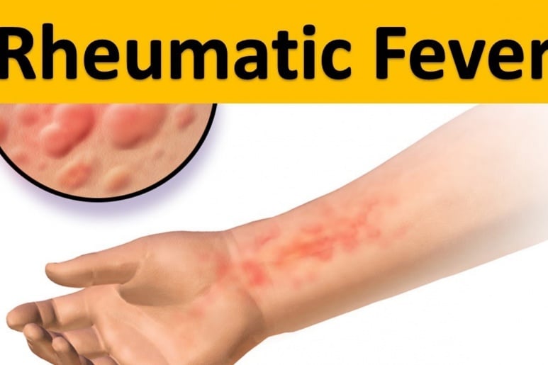 Rheumatic fever - Ảnh minh họa 4