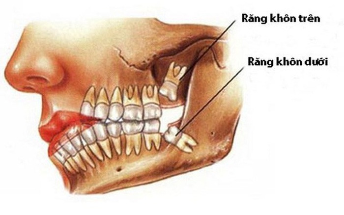 Răng khôn bị kẹt - Ảnh minh họa 2