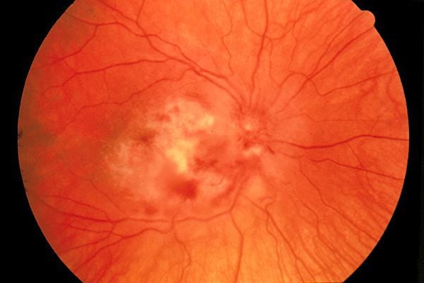 Retinitis Pigmentosa - Ảnh minh họa 3