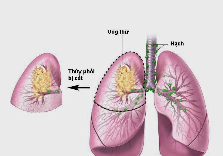 Small-cell Carcinoma - Ảnh minh họa 3