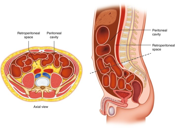 Retroperitoneal hemorrhage - Ảnh minh họa 2