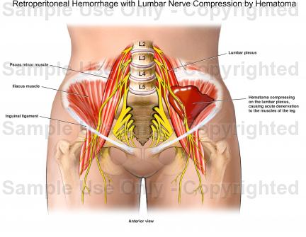 Retroperitoneal hemorrhage - Ảnh minh họa 1