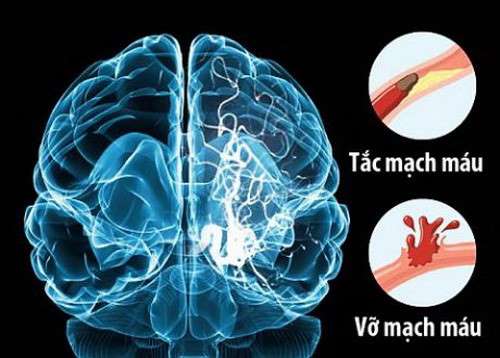 Stroke - Ảnh minh họa 4