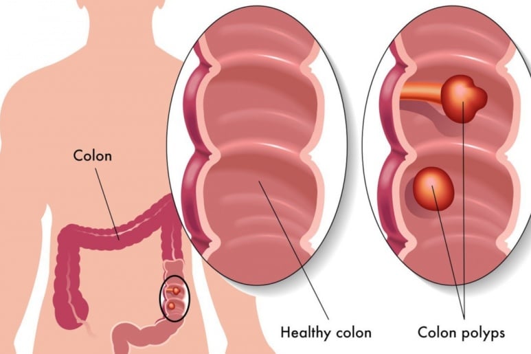 Colon polyps - Ảnh minh họa 1