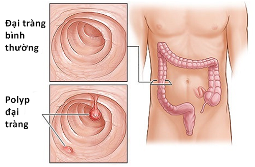 Colon polyps - Ảnh minh họa 3