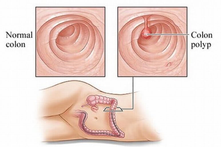 Colon polyps - Ảnh minh họa 4