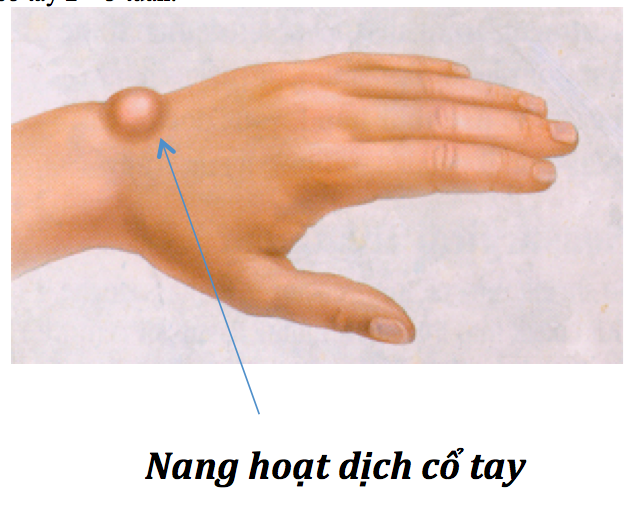 Synovial Cyst - Ảnh minh họa 4