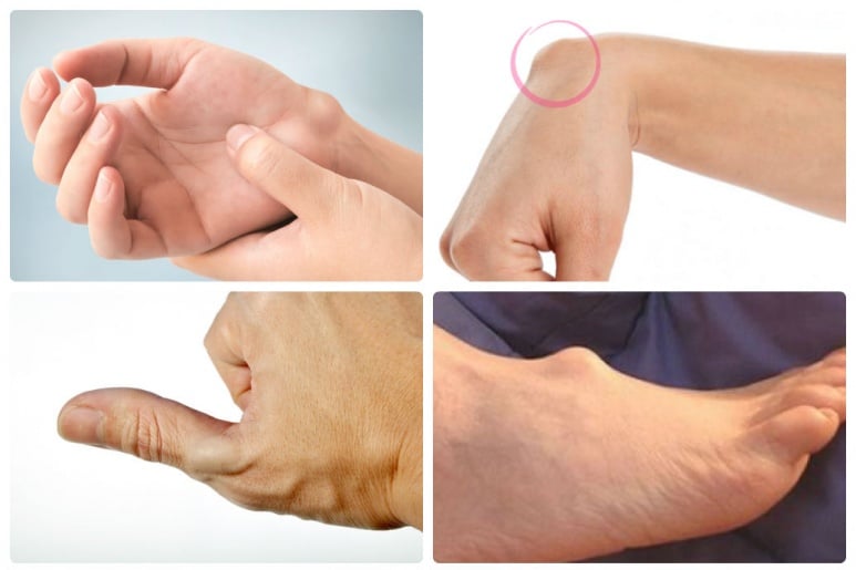 Synovial Cyst - Ảnh minh họa 1