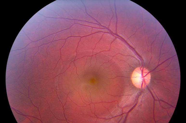 Central Serous Chorioretinopathy - Ảnh minh họa 1