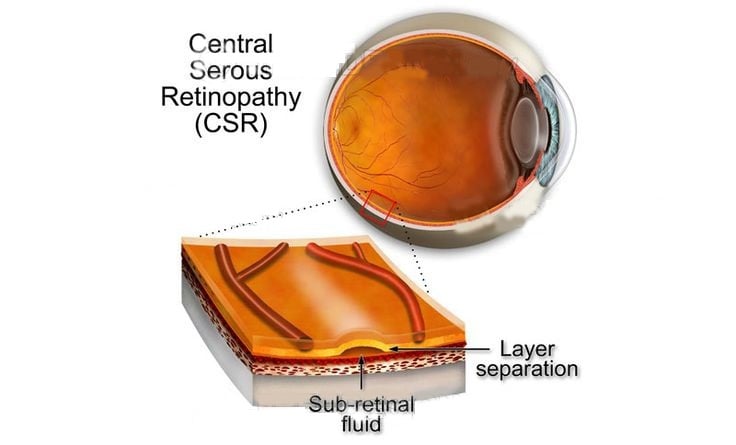 Central Serous Chorioretinopathy - Ảnh minh họa 2