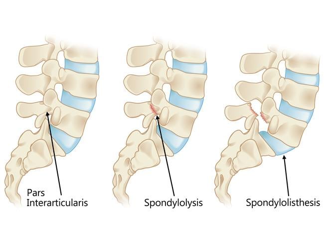 Spondylolisthesis - Ảnh minh họa 1