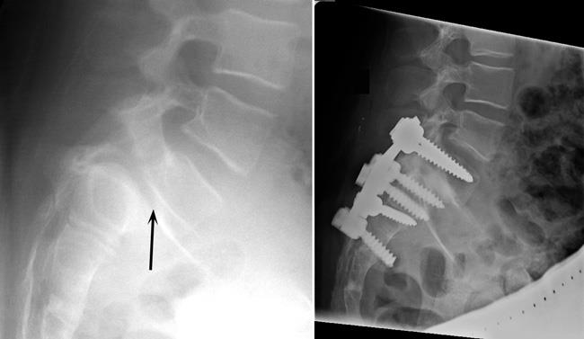 Spondylolisthesis - Ảnh minh họa 2