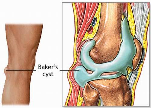 Synovial Cyst - Ảnh minh họa 2