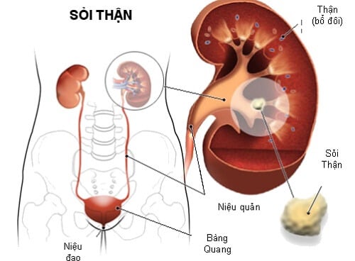 Sỏi niệu quản - Ảnh minh họa 2