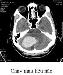 Chảy máu tiểu não - Ảnh minh họa 1