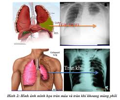 Chấn thương ngực - Ảnh minh họa 2