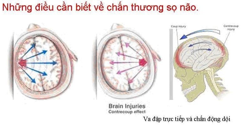 Chấn thương đầu - Ảnh minh họa 3