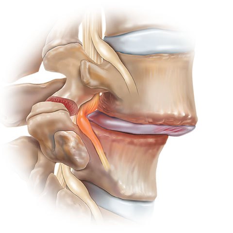 Spondylolisthesis - Ảnh minh họa 3