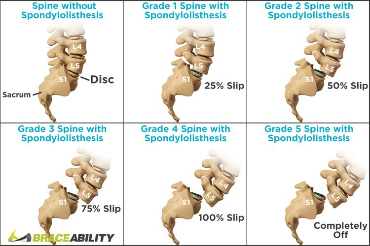 Spondylolisthesis - Ảnh minh họa 4