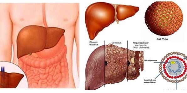 Cirrhosis - Ảnh minh họa 3