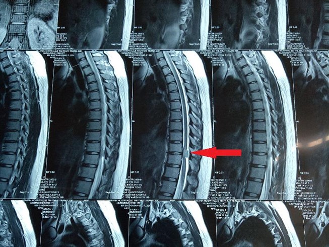 Spinal Cord Tumor - Ảnh minh họa 2